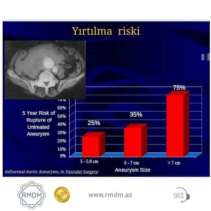 64 yaşlı kişi qarnında ağrı ilə həkimə getdi, qalça damarında "partlayan bomba" aşkarlandı -  Əməliyyat