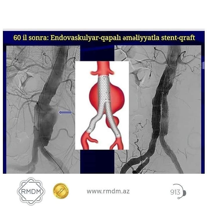64 yaşlı kişi qarnında ağrı ilə həkimə getdi, qalça damarında "partlayan bomba" aşkarlandı -  Əməliyyat