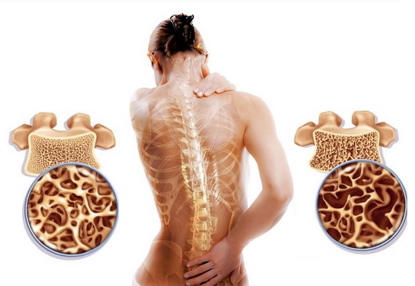 Osteoporoz - sümüklərin əriməsinə qarşı Alman metodu  