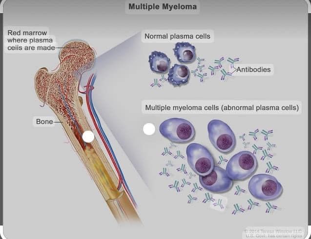 Səbəbsiz anemiya bu xəstəliyin əlaməti ola bilər  - Hematoloq həkim