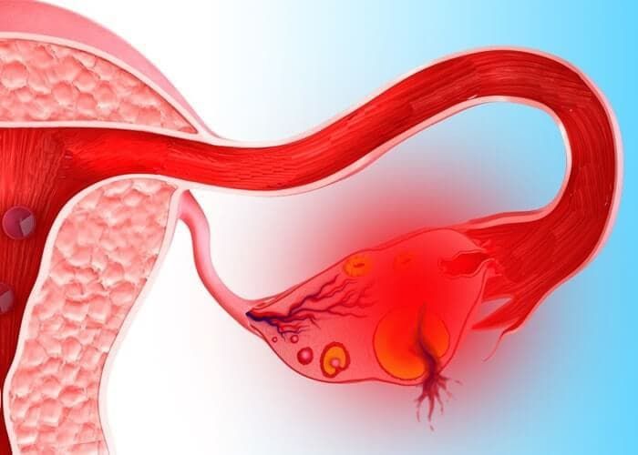 Yumurtalıq apopleksiyası – partlaması nədir?  