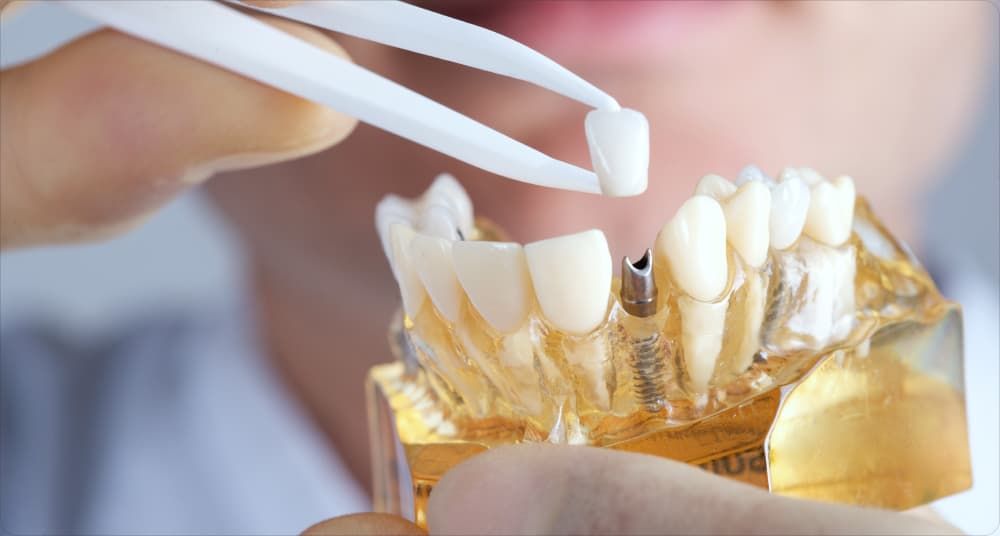 Diş implantlarını neçə müddətdən bir dəyişmək lazımdır? 