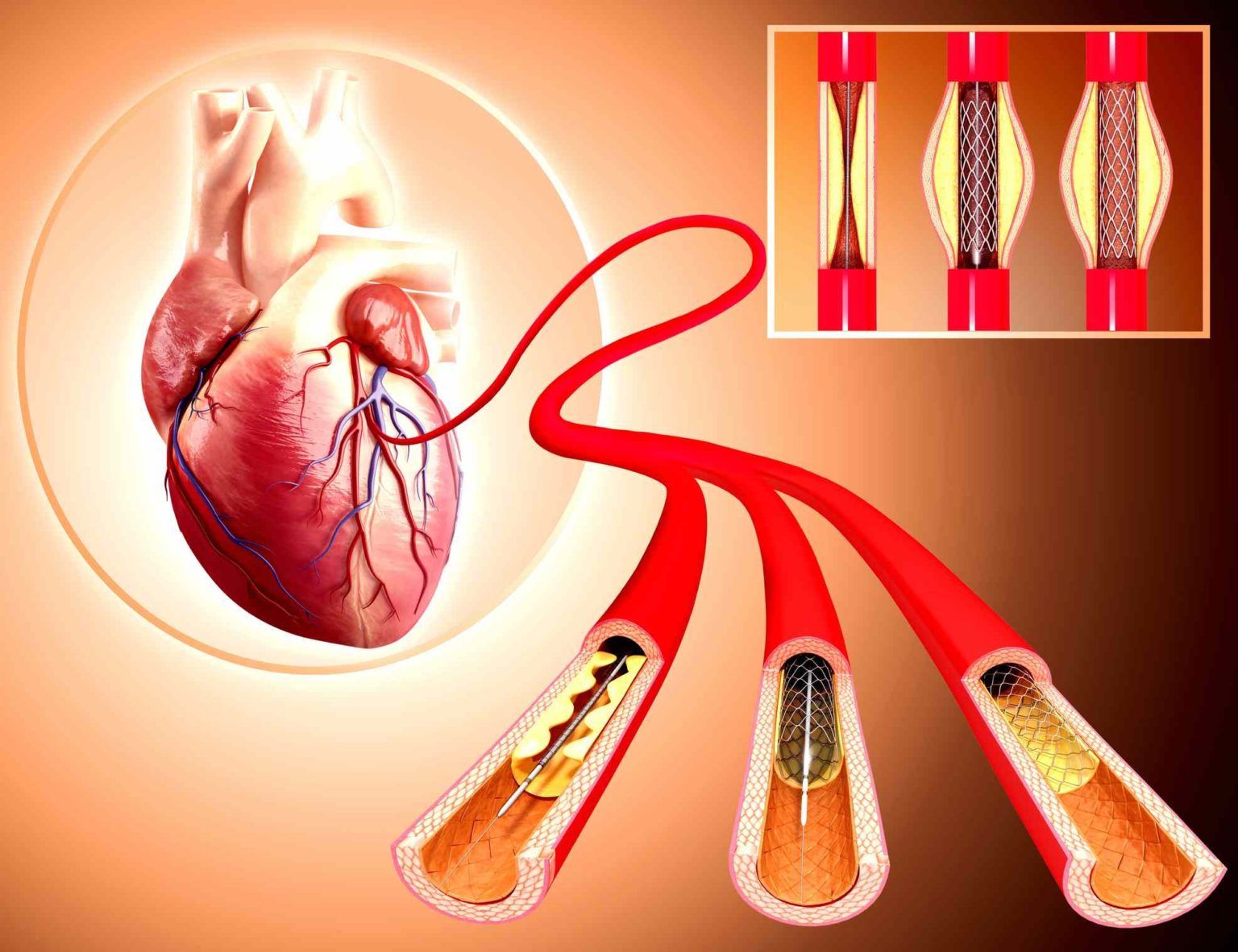 Azərbaycanda hər 5 nəfərdən birinin ürəyində stent var - AÇIQLAMA