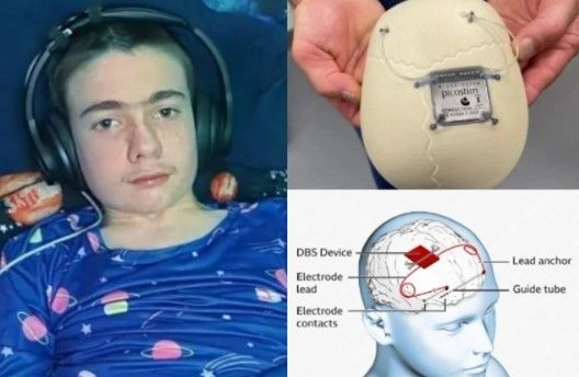 Epilepsiya xəstəsi olan yeniyetmənin beyninə implant yerləşdirildi 