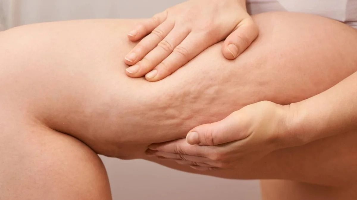 Selülit kimi görünən "lipedema" nədir? -  Müalicəsi