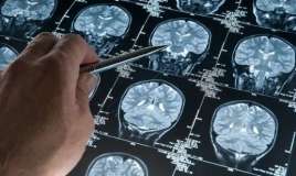 Musiqi dinləməyin Alzheimer xəstələrinə faydaları  AÇIQLANDI