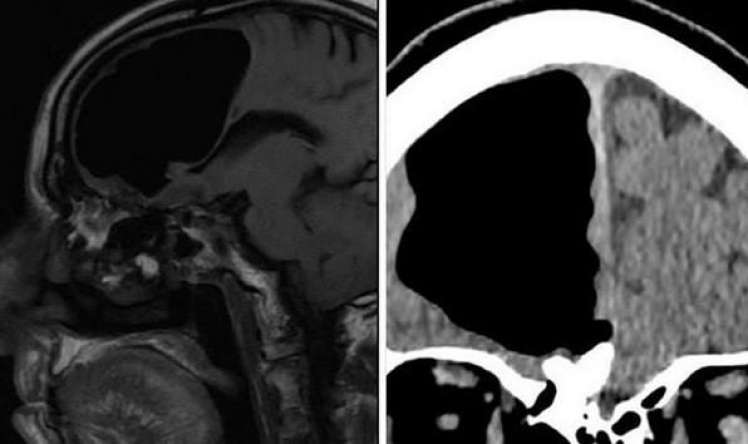 Baş ağrısı ilə həkimə getdi -  Beyni olmadığı ortaya çıxdı