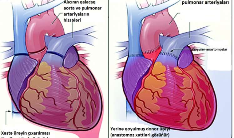  “Azərbaycanda ürək transplantasiyası həyata keçiriləcək"  - Bakıda kardioloqların 40 illiyi 