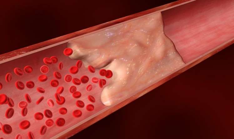 Damar tıxanmasını da antibiotiklə müalicə edəcəklər –  ALİMLƏR