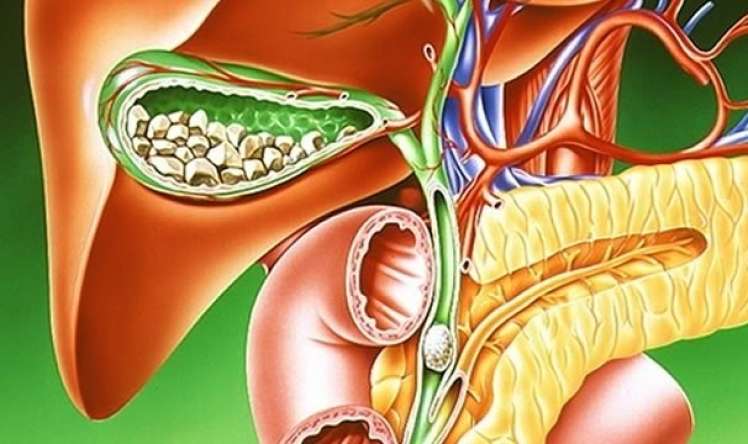 Xroniki daşsız xolesistit nədir? -  Həkim səbəb və müalicəsini AÇIQLADI