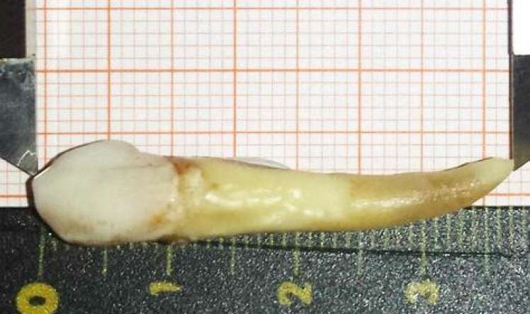 Stomatologiya tarixində xəstədən ən uzun diş çıxarıldı –  3,7 sm-lik rekord