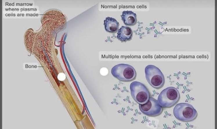 Səbəbsiz anemiya bu xəstəliyin əlaməti ola bilər  - Hematoloq həkim