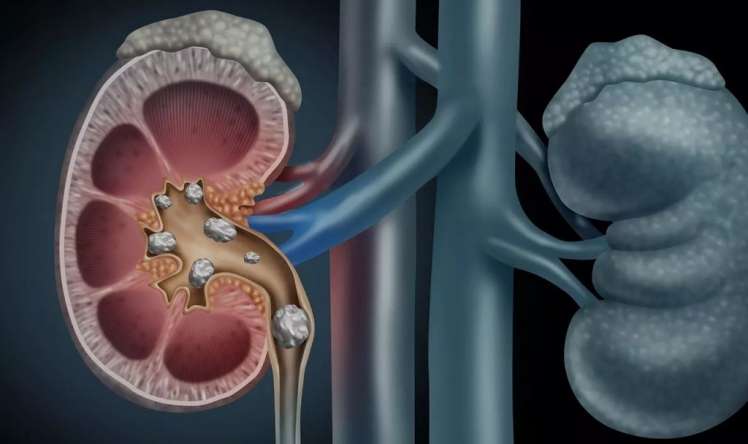 Yayda böyrək daşlarının qarşısını necə almalı? 
