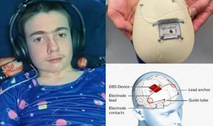 Epilepsiya xəstəsi olan yeniyetmənin beyninə implant yerləşdirildi 