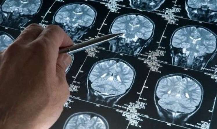 Musiqi dinləməyin Alzheimer xəstələrinə faydaları  AÇIQLANDI